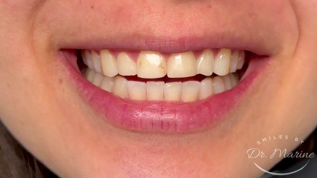 Porcelain Veneers Smile Makeover in Glendale, CA 