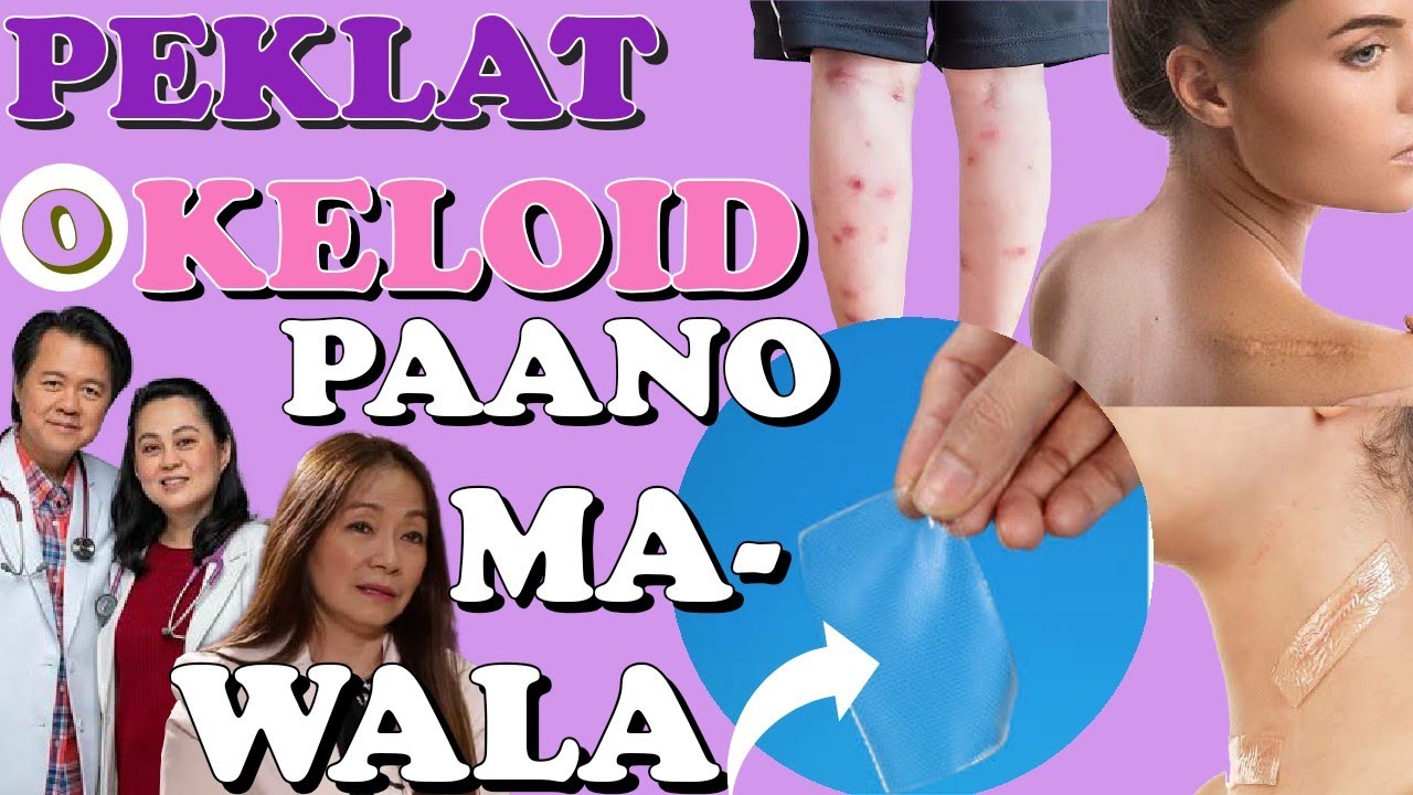 Peklat o Keloid: Paano Mawala? - Tips ni Doc Katty Go-Estrada at Doc Willie Ong 