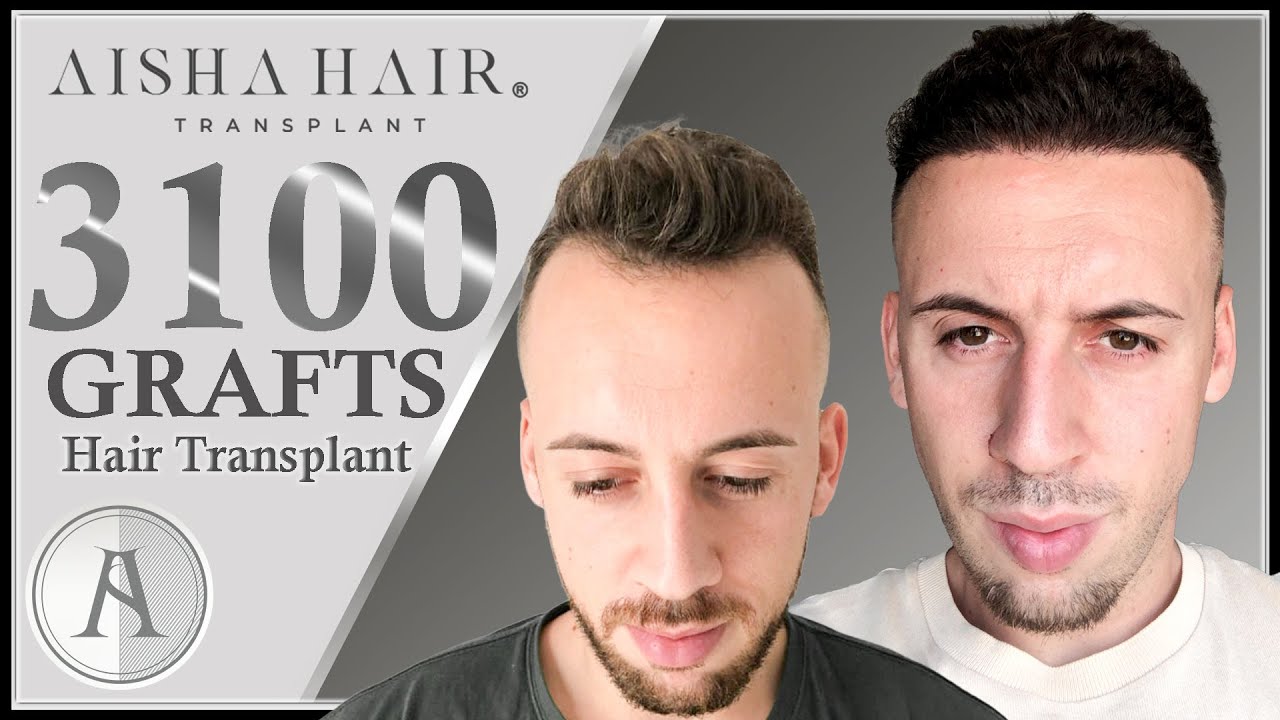 FUE Hair Transplant Results in Turkey | 3100 GRAFTS | Injerto Capilar FUE Resultados en Turquía