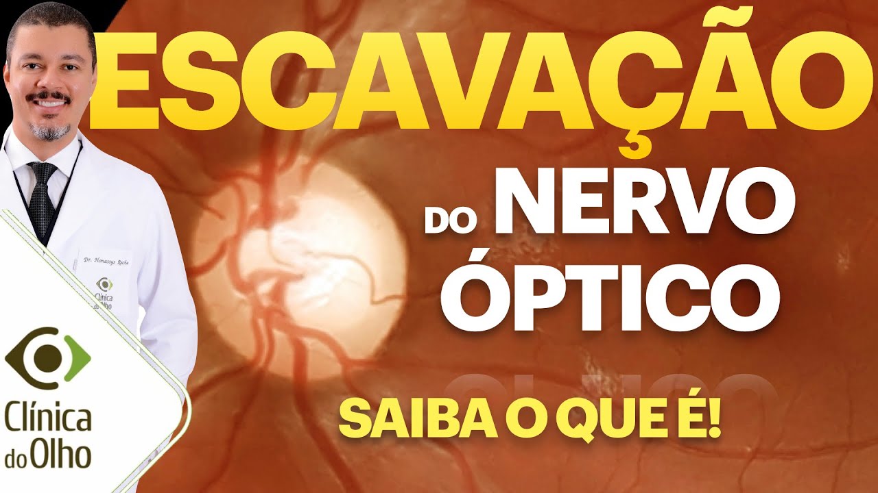 Escavação: você já saiu do oftalmo com dúvida sobre fundo de olho. Veja a escavação do nervo óptico.