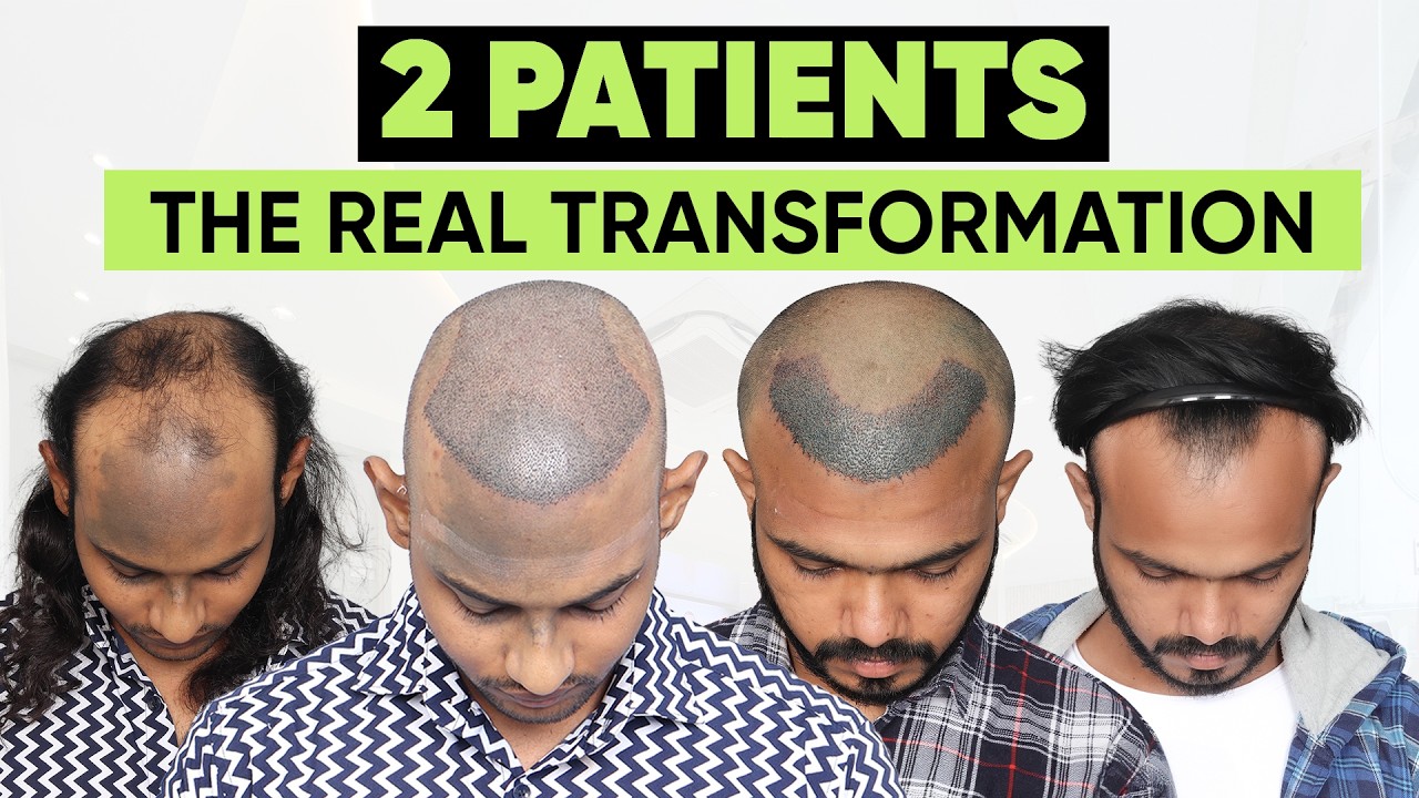 Hair Transplant in Udaipur (HX-GDST)  | Best Results & Cost of Hair Transplant in Udaipur