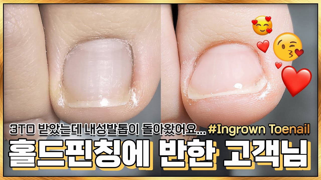 [특허관리] 3TO 받았는데 되돌아온 내성발톱, 홀드핀칭 관리 받고 기립박수 하신 고객님! 😘 / 내성발톱 / Ingrown Toenail