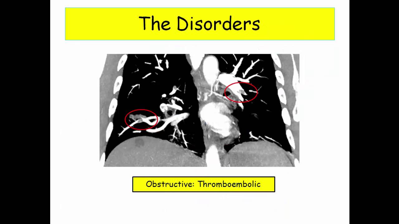 12DaysinMarch, Pulmonary Vascular Disease, Part 2 - The Disorders for USMLE Step One