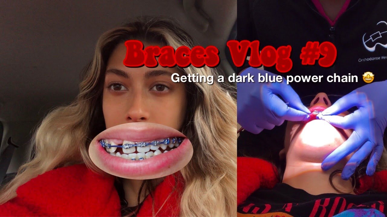 BRACES VLOG #9: Getting a dark blue power chain and colored elastics