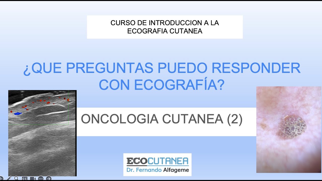 TALLER DE INTRODUCCION A LA ECOGRAFIA CUTANEA: TUMORES CUTANEOS (PARTE 2)