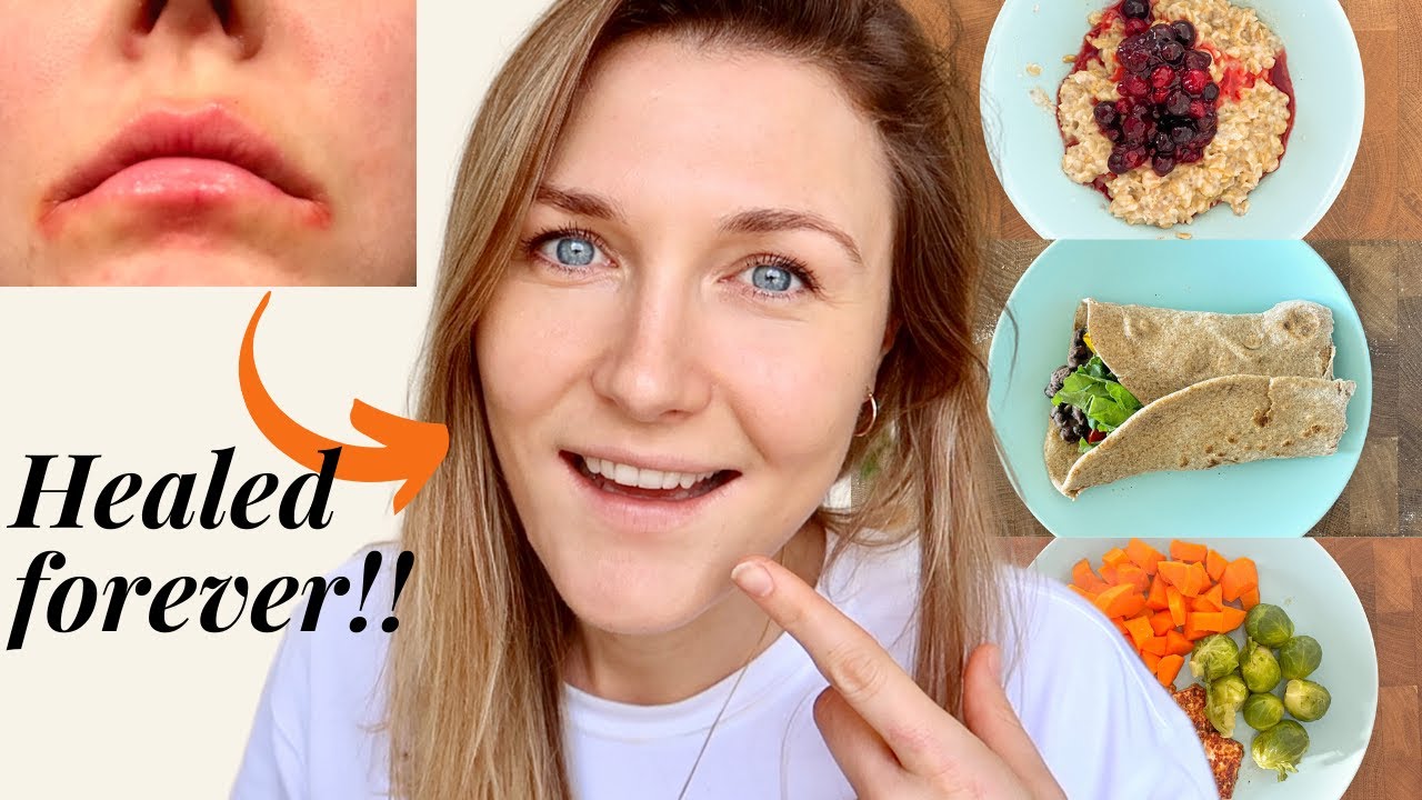 WHAT TO EAT TO HEAL LIP ECZEMA /ANGULAR CHEILITIS FOREVER! How to heal lip eczema full day of eating