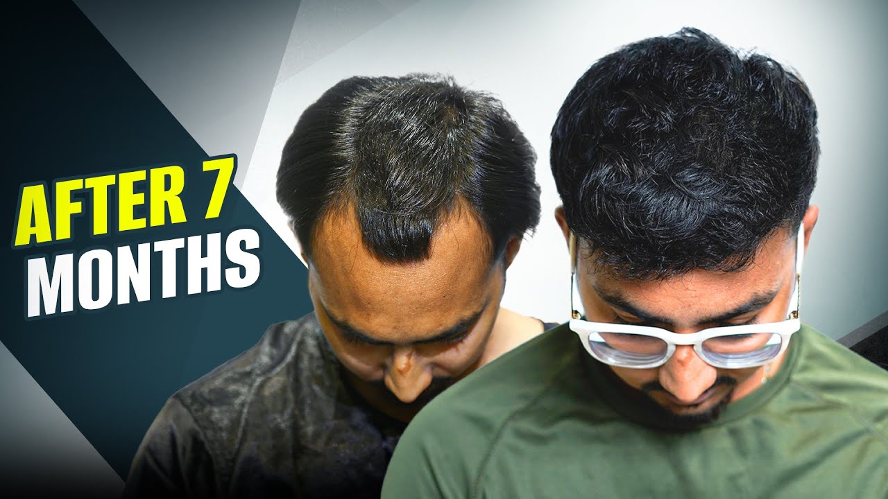 My Hair Transplant Experience - INCREDIBLE RESULTS 😎 | Kolkata | New Roots