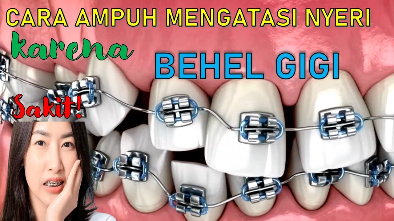 Tips ampuh meredakan nyeri karena behel kawat gigi‼️