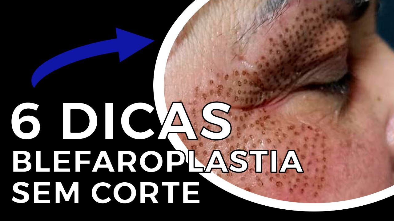 Como fazer a Blefaroplastia sem Corte - 6 DICAS!!
