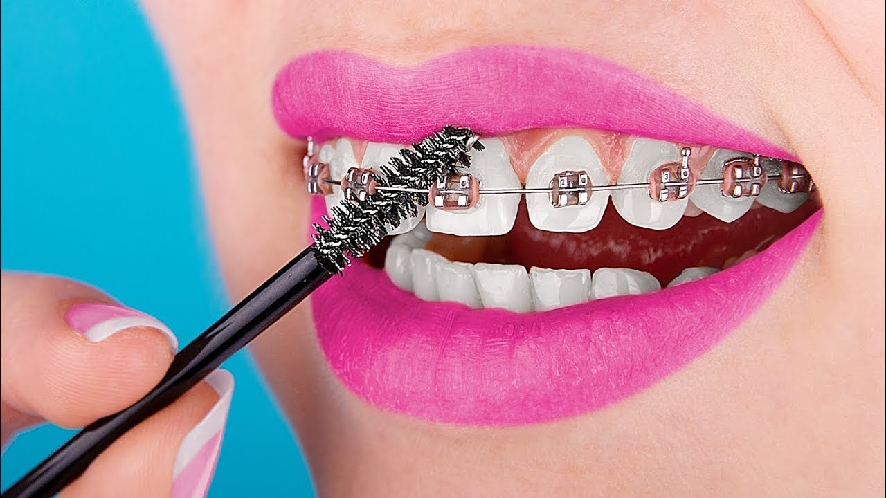 15 Trucchetti Per Il Tuo Apparecchio Ortodontico Che Renderanno La Tua Vita Migliore