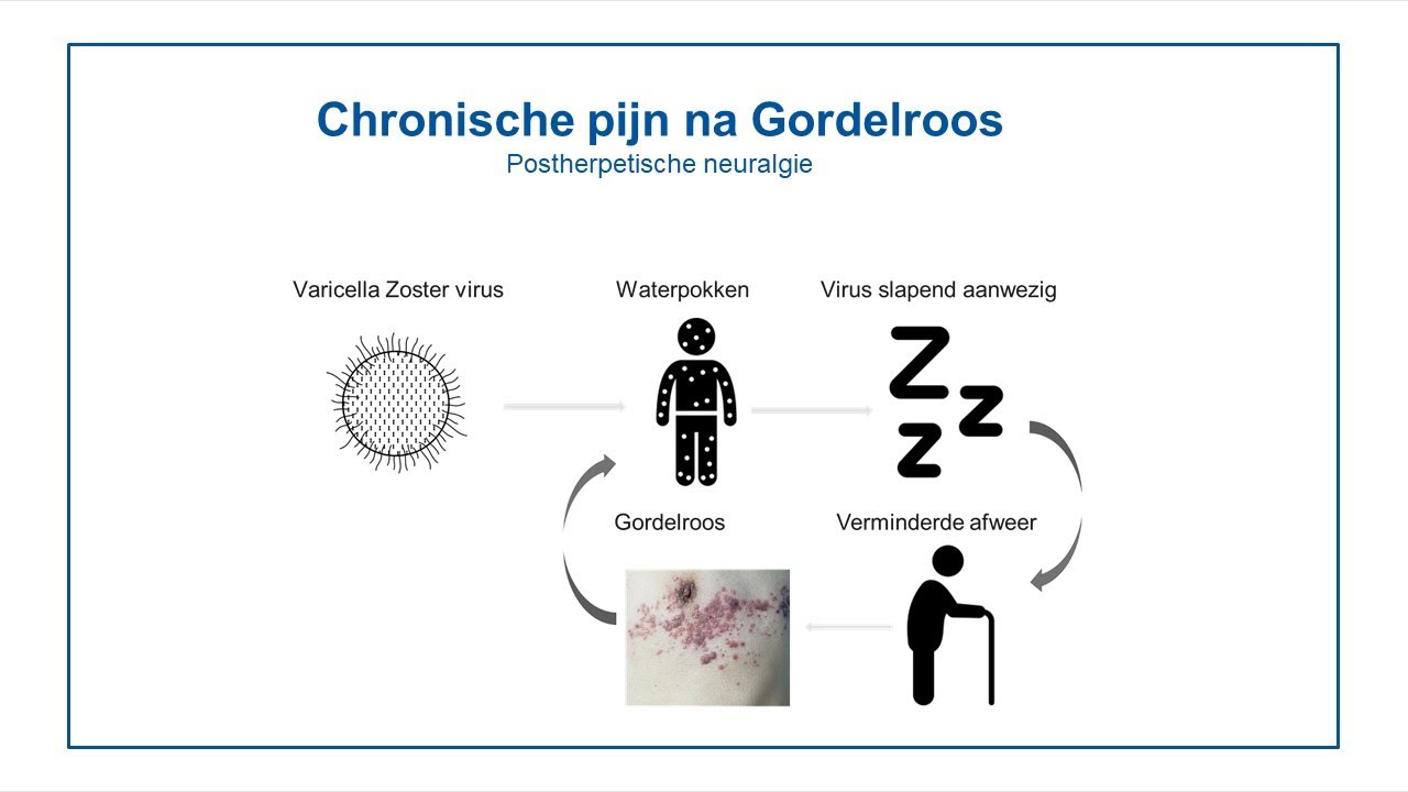 Chronische pijn na Gordelroos