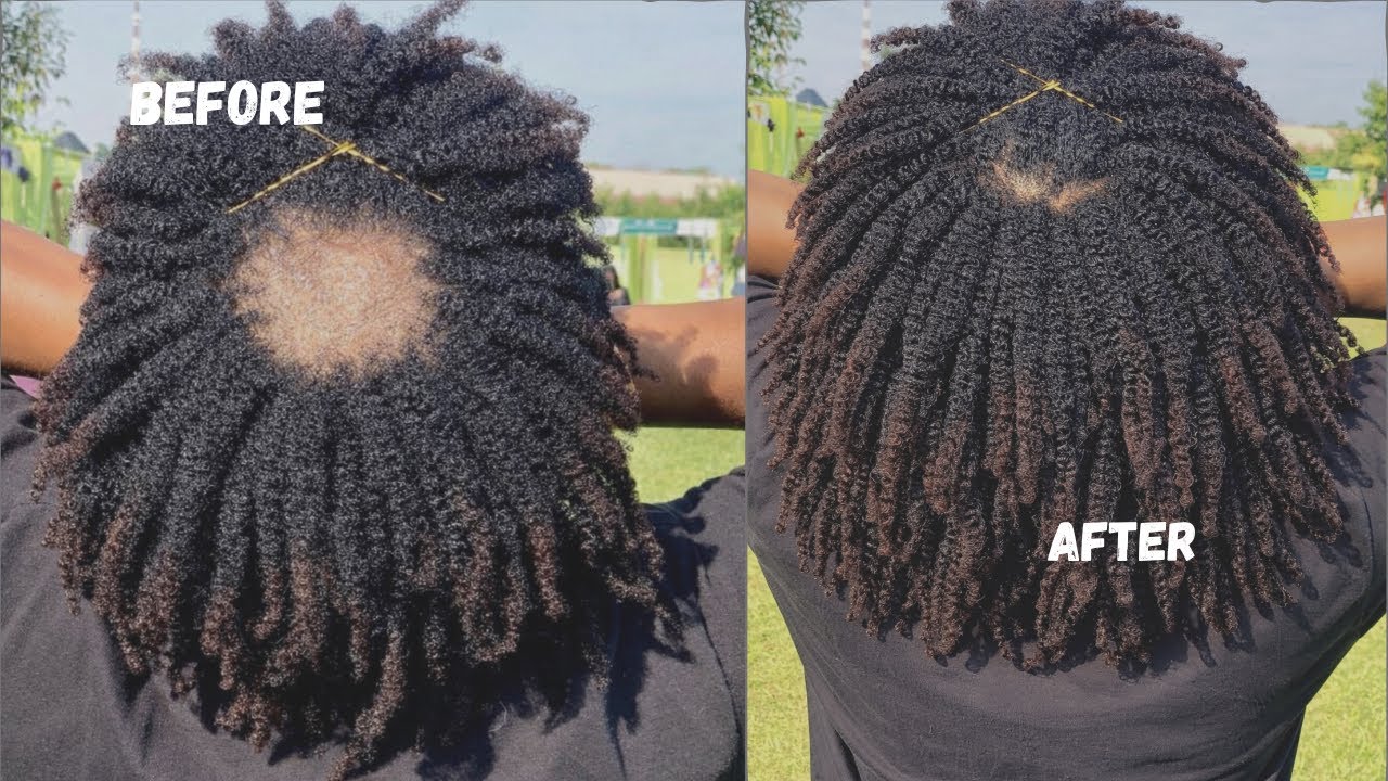 I went bald because I didn’t know these things! My 4C hair stopped growing