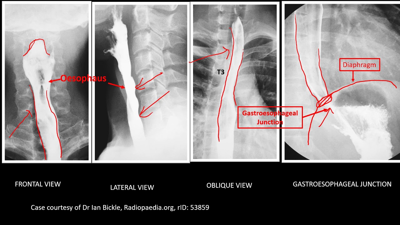 Abdominal X-Ray: Barium swallow, Barium Meal and Barium Enema
