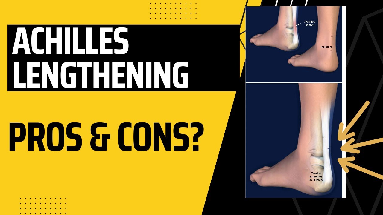 Is Achilles Lengthening Surgery Risky? Pros & Cons