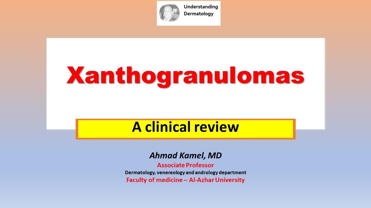 Xanthogranulomas...A clinical Review