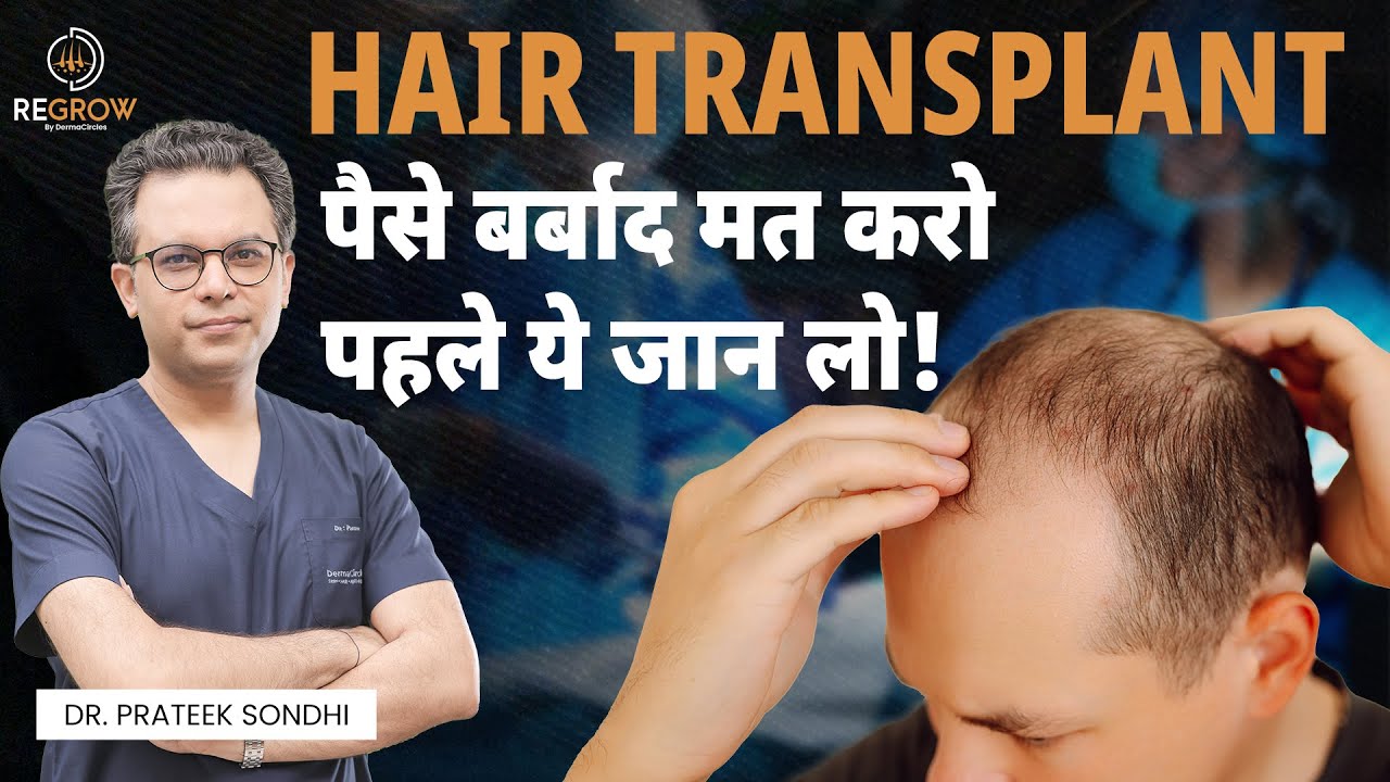 Things to Know Before Hair Transplant | Hair Transplant in Delhi | Dr. Prateek Sondhi