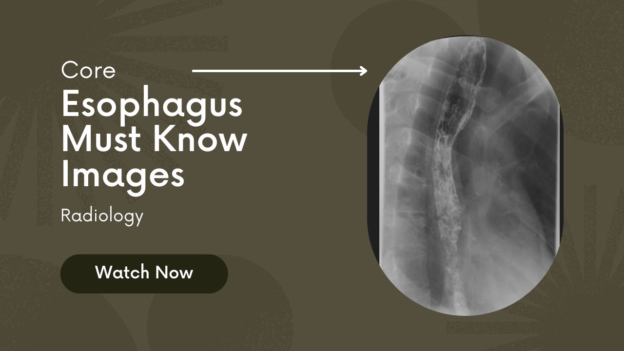 Esophagus: Core Must Know Images #radiology #Lecture
