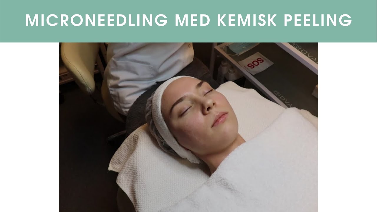 Dermapen behandling med kemisk peeling Stockholm