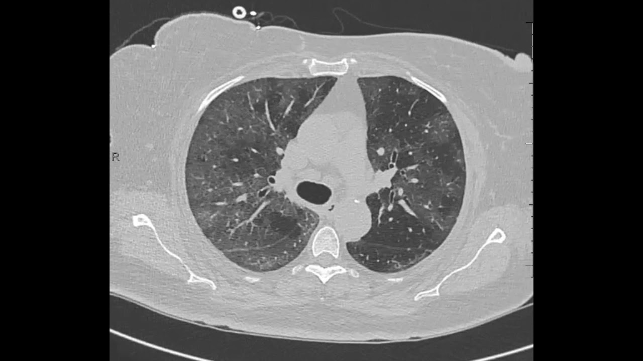 Crazy paving pattern on CT in COVID-19 pneumonia