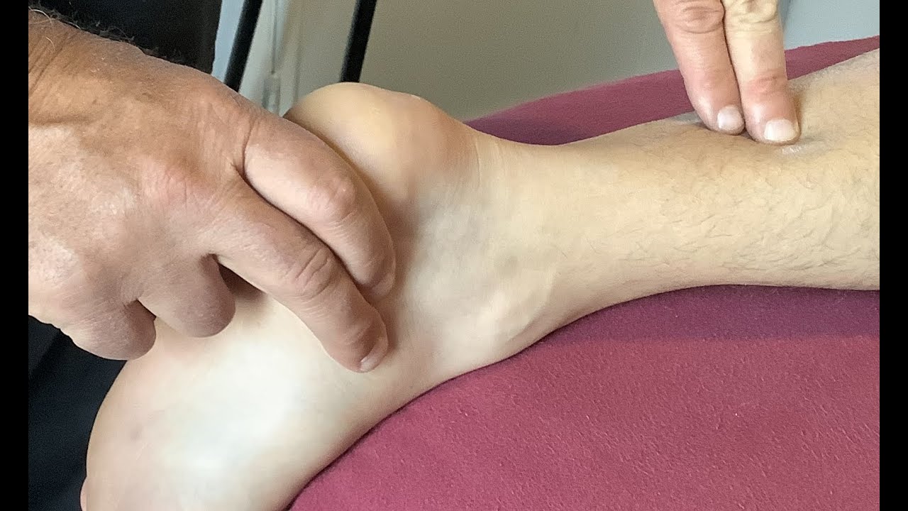 Pulled Achilles Tendon: Speed up Healing