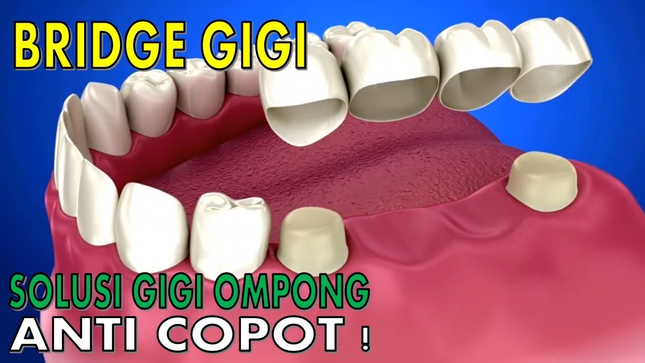 Solusi gigi ompong anti copot‼️Bridge gigi | jembatan gigi | Dokter Gigi Channel