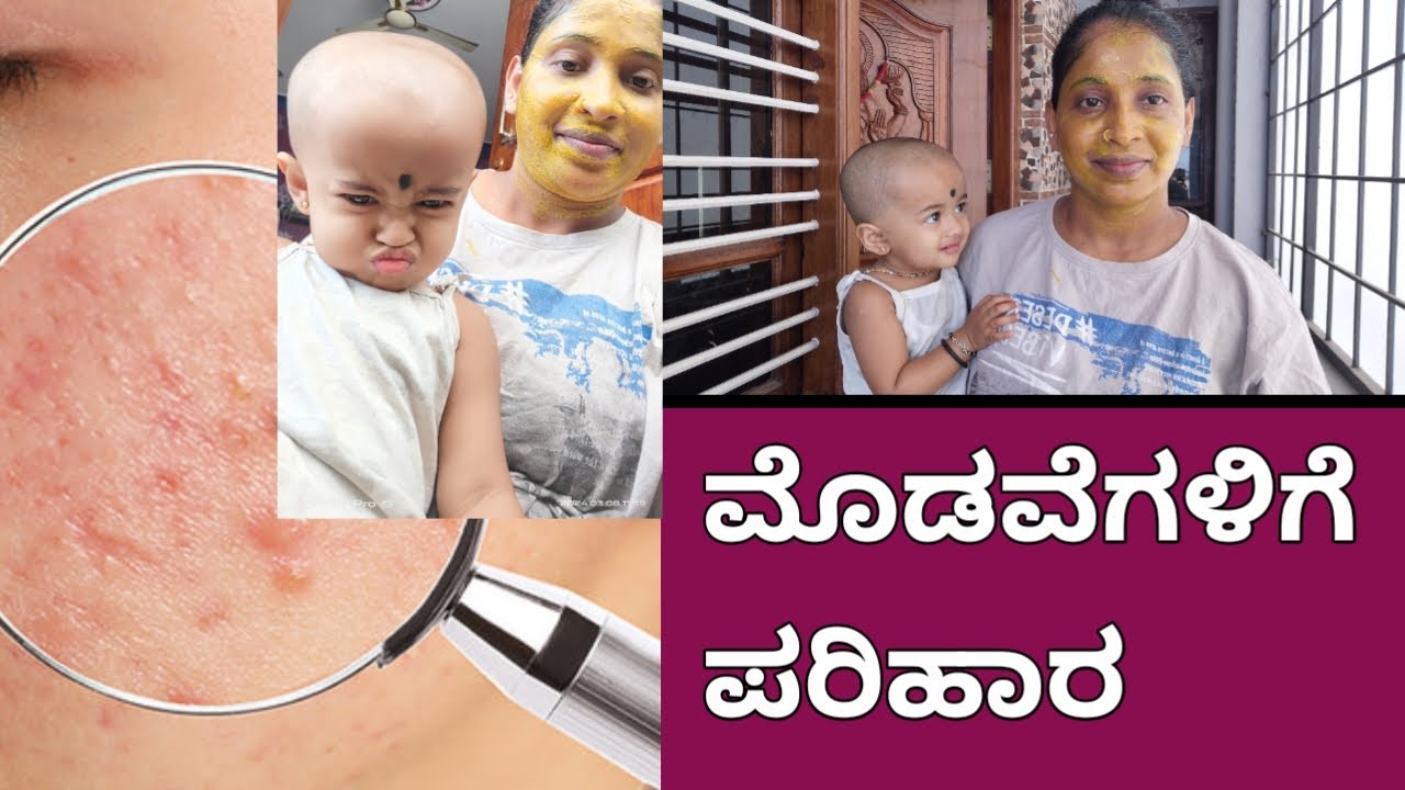 ಮೊಡವೆಗಳಿಗೆ ಪರಿಹಾರ/Home Remedy to Remove Pimples/How to Remove Pimples#priyapurushothamkannadavlogs.