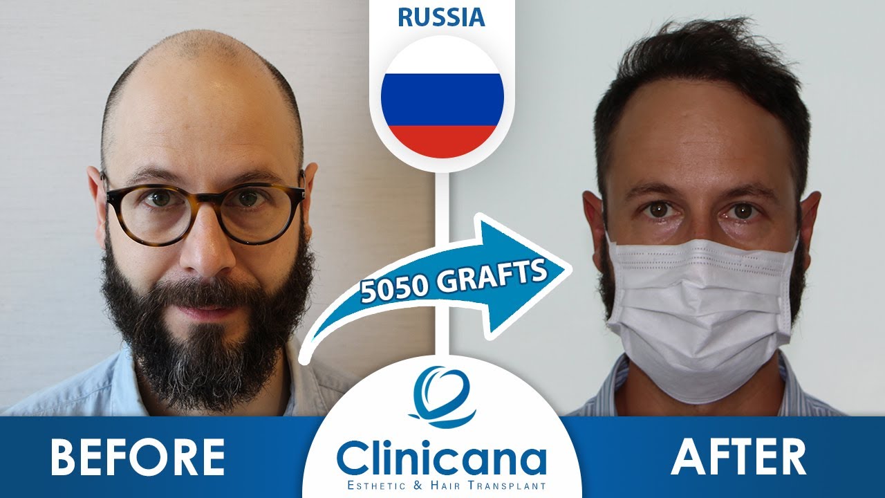 Alexey's Hair Transplant Journey in Istanbul Turkey | Clinicana reviews