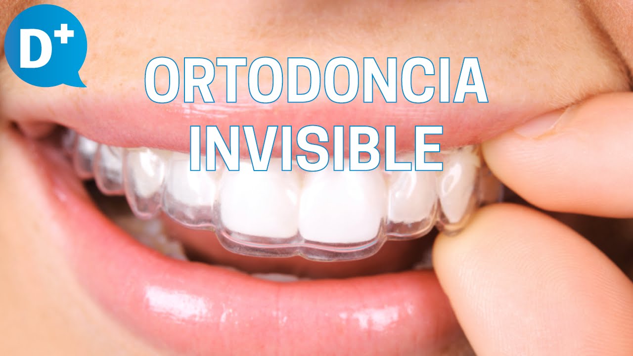 Descubre las ventajas de la Ortodoncia invisible