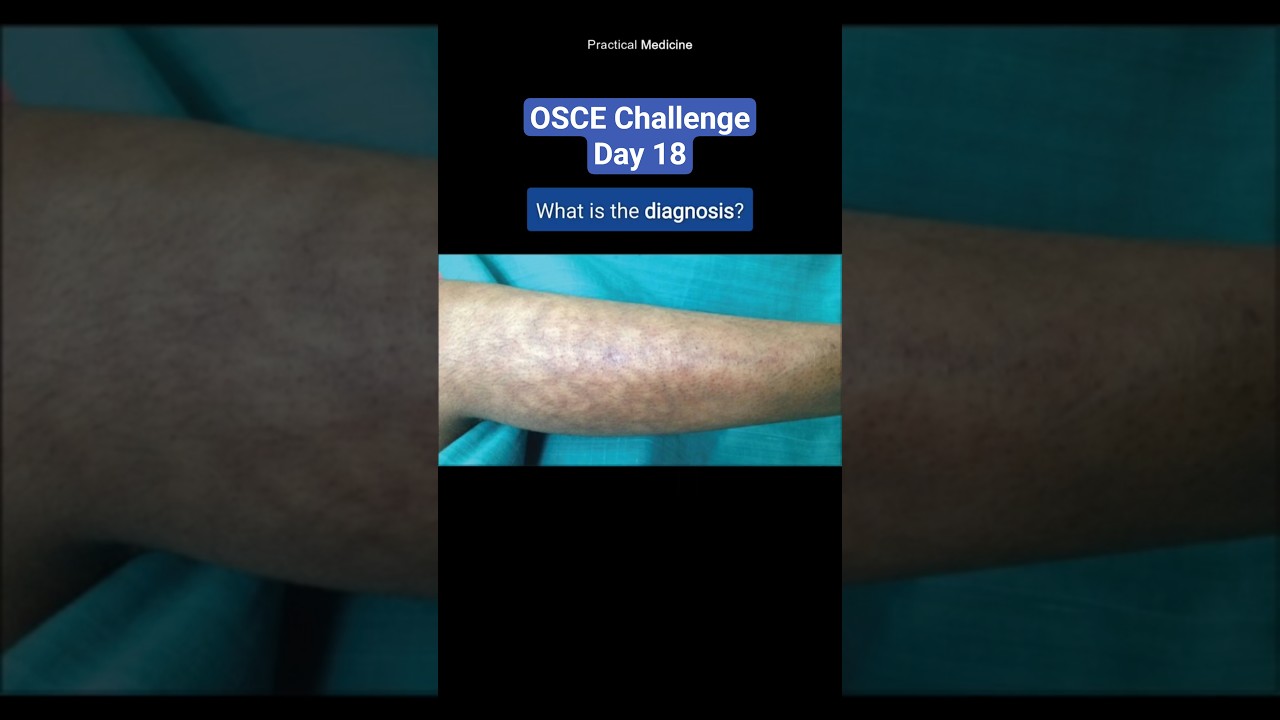 [OSCE Challenge] Spot Diagnosis #osce #diagnosis #spotdiagnosis #mrcpuk #dermatology #livedo