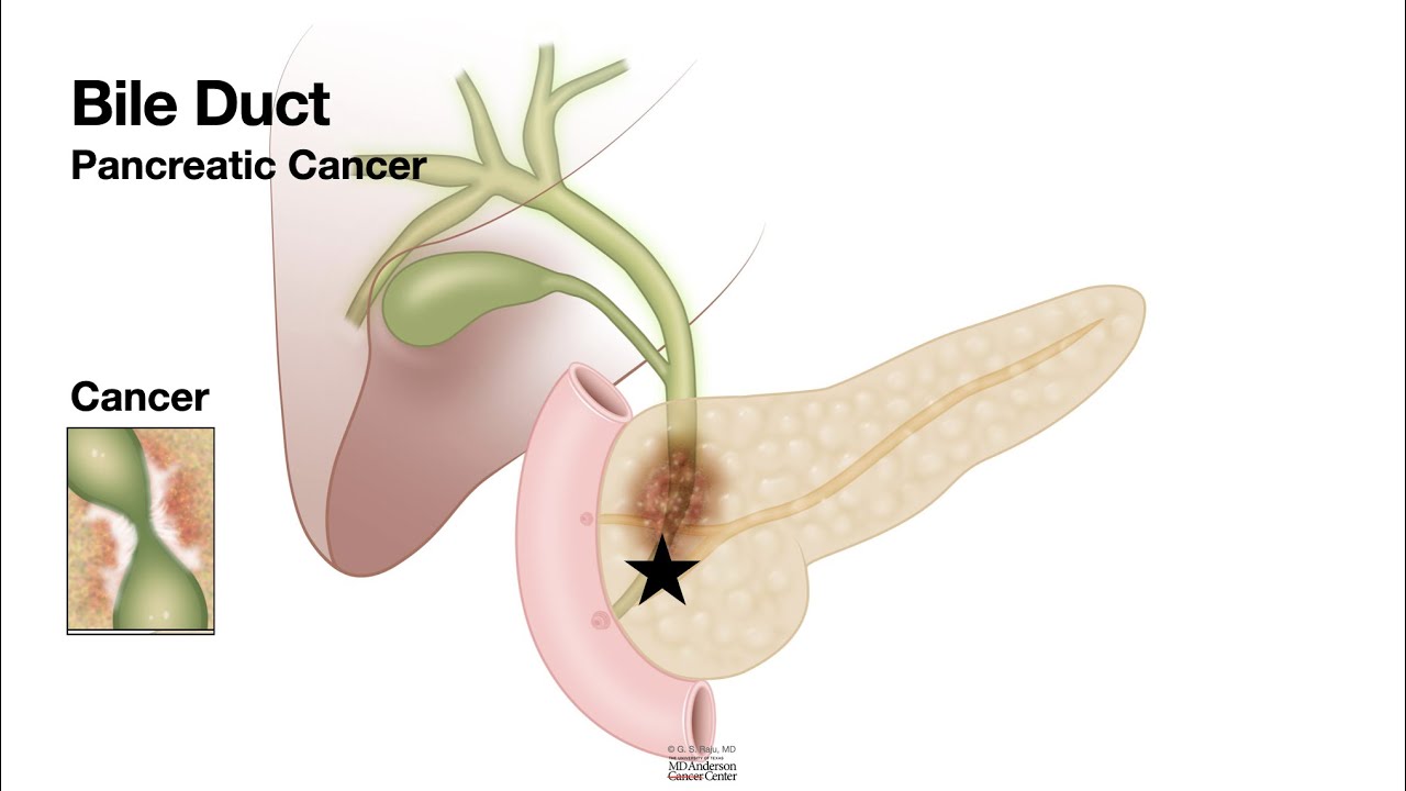 HCC 1474 2c Bile duct stricture