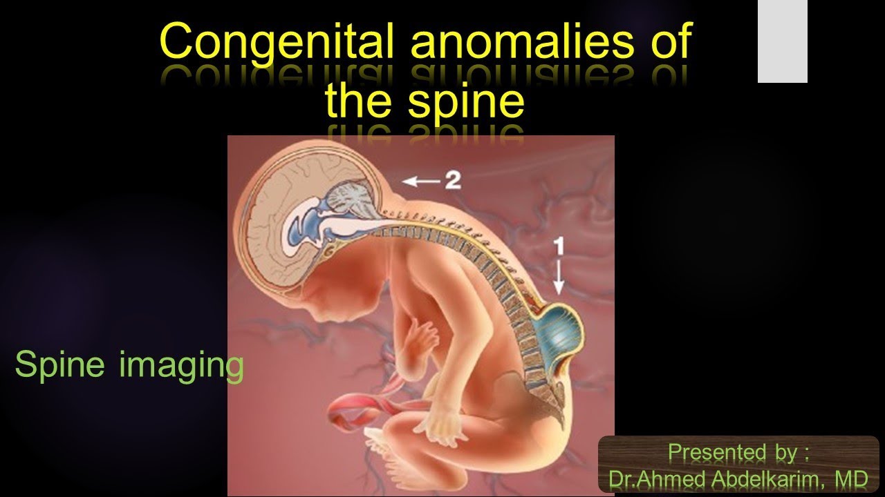 2-Congenital anomaly of the spine I