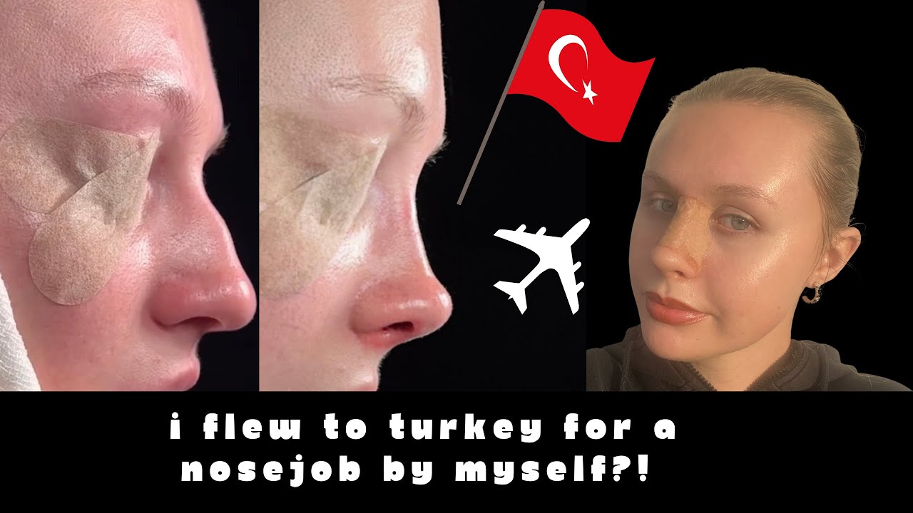 I flew ALONE to Turkey for a closed rhinoplasty?! (NOSE JOB) hospital tests, recovery & cast removal