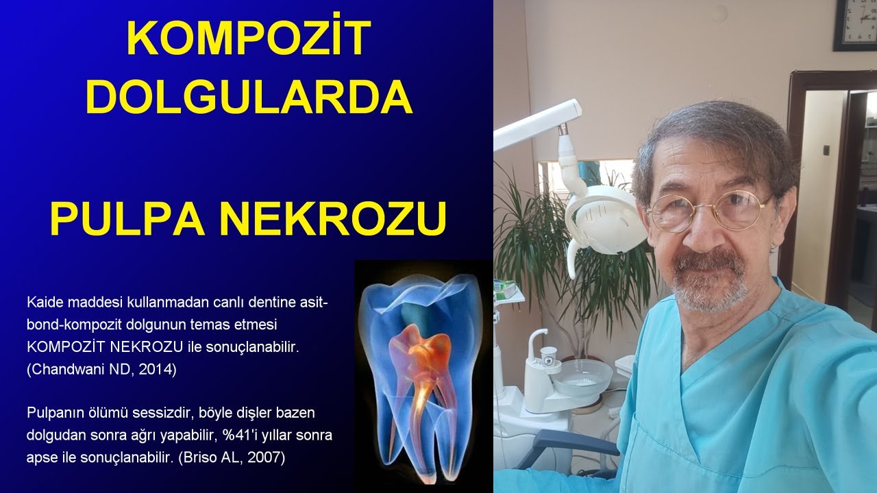 Beyaz kompozit diş dolgusundan sonra meydana gelen diş ağrısı nekrozu ve diş apsesi Kompozit nekrozu