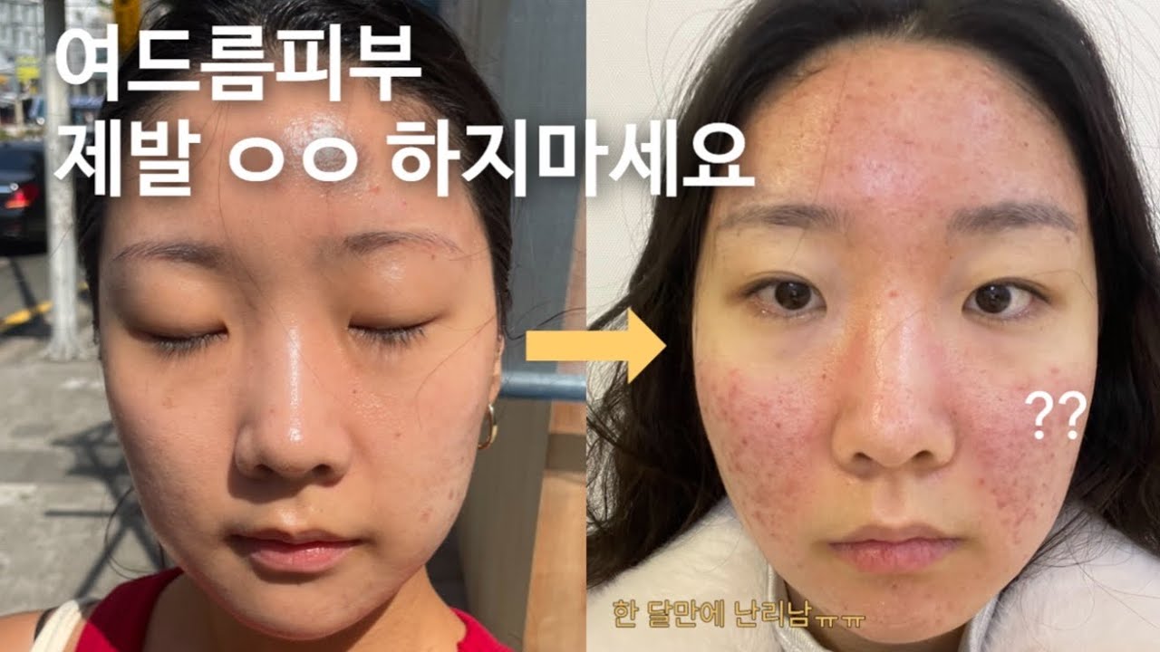 여드름피부 무조건 피해야 하는 세안법 ❌| 폼클렌징 끊기! | 여드름세안법 | 녹두세안 곡물세안법