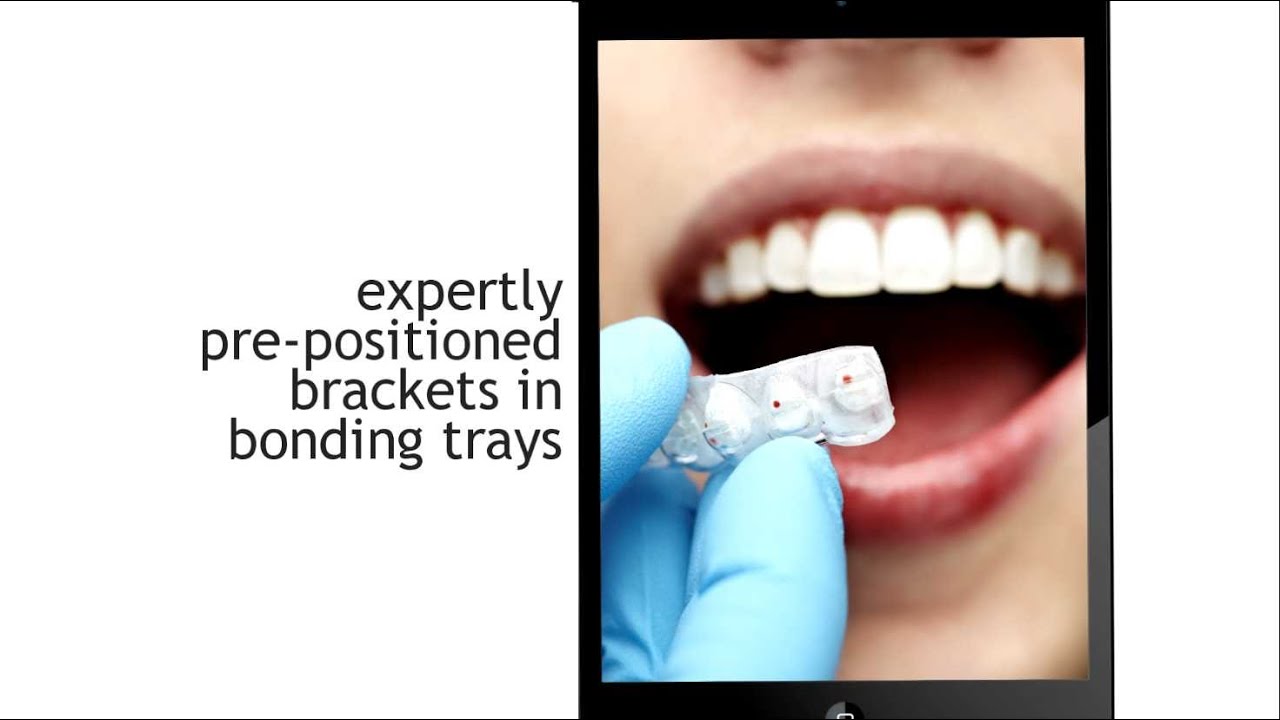 What is Six Month Smiles?