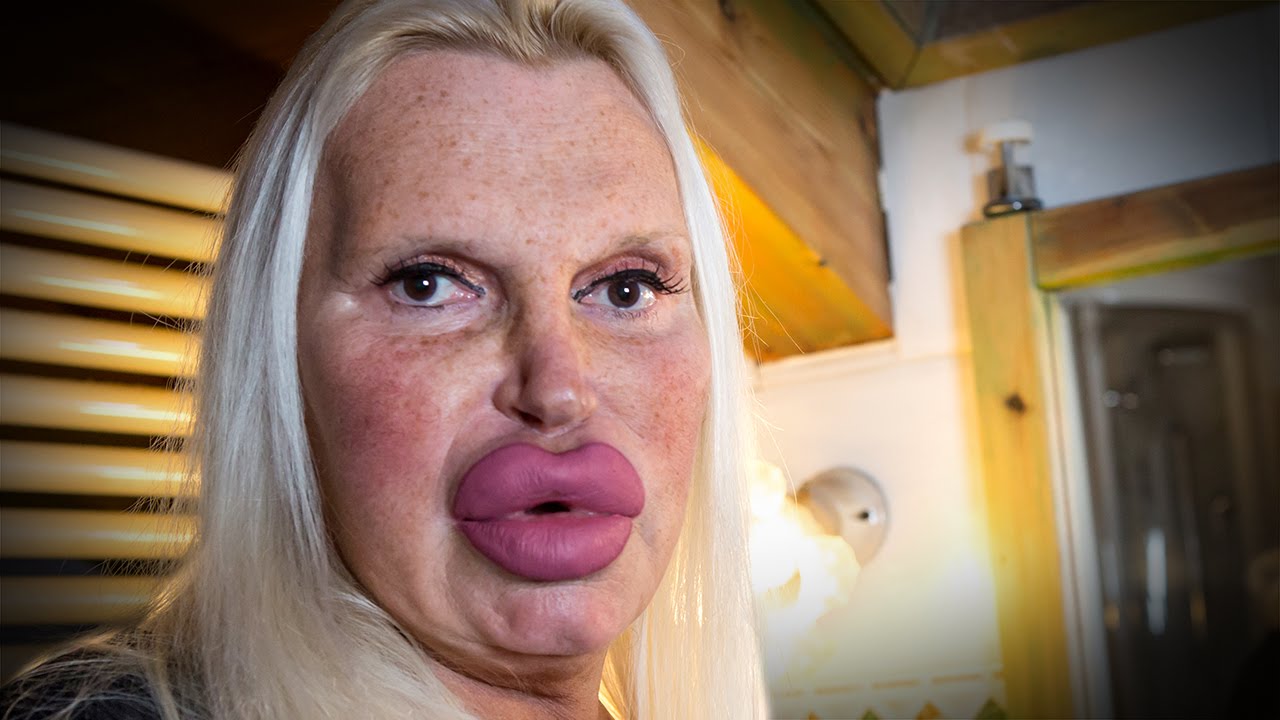 Surgery Obsessive Spends $76,000 In Quest For Perfection