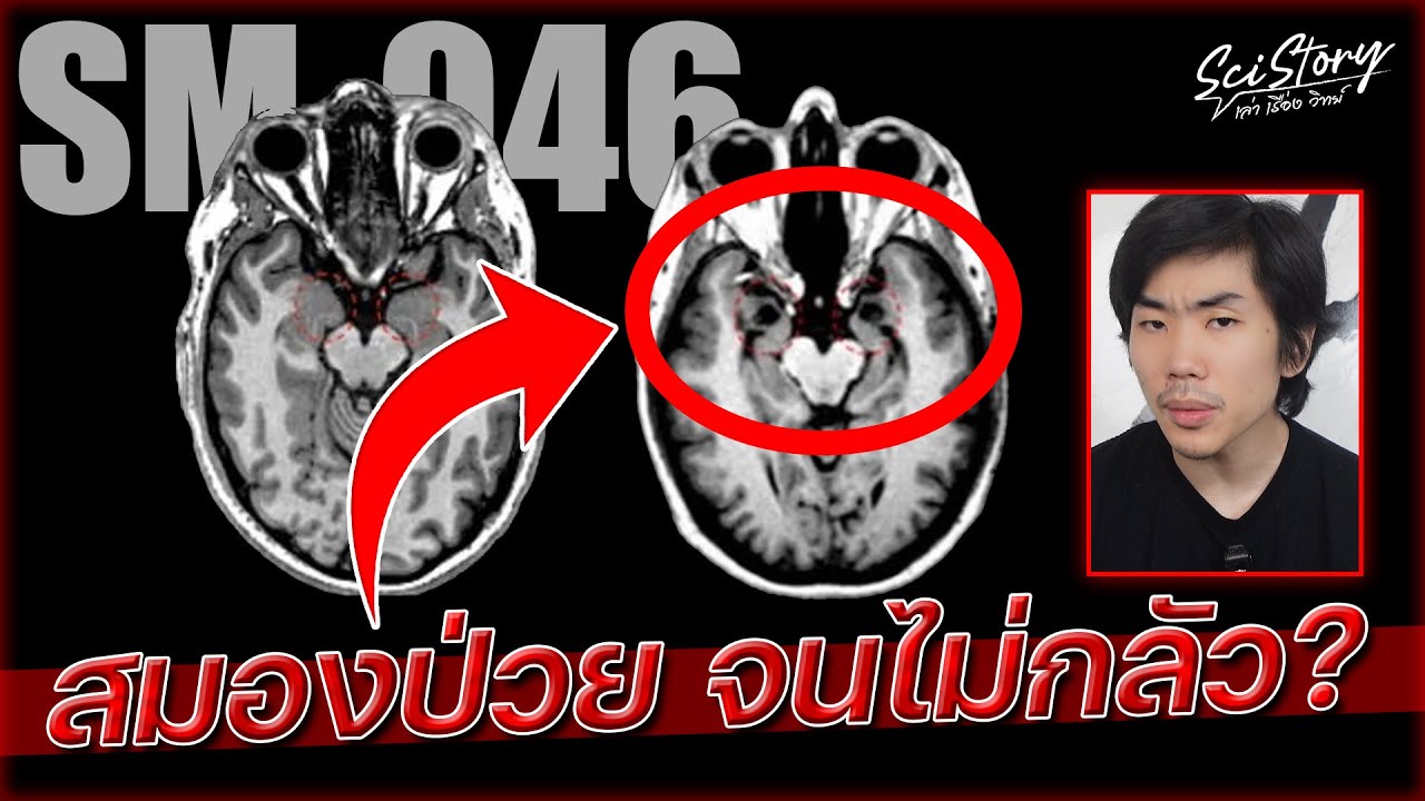 คนไร้ความกลัว? เมื่อสมอง ‘ป่วย’ จนไม่รู้จักกลัว? | Sci Story เล่า เรื่อง วิทย์