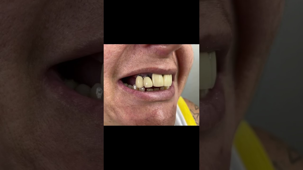 Pr&oacute;tese total Protocolo - Carga Imediata