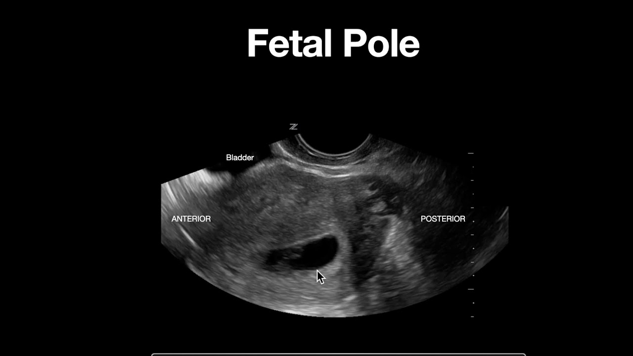 Definitive IUP - Fetal Pole