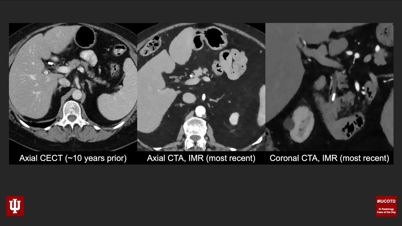 Abdominal Case of the Day 33