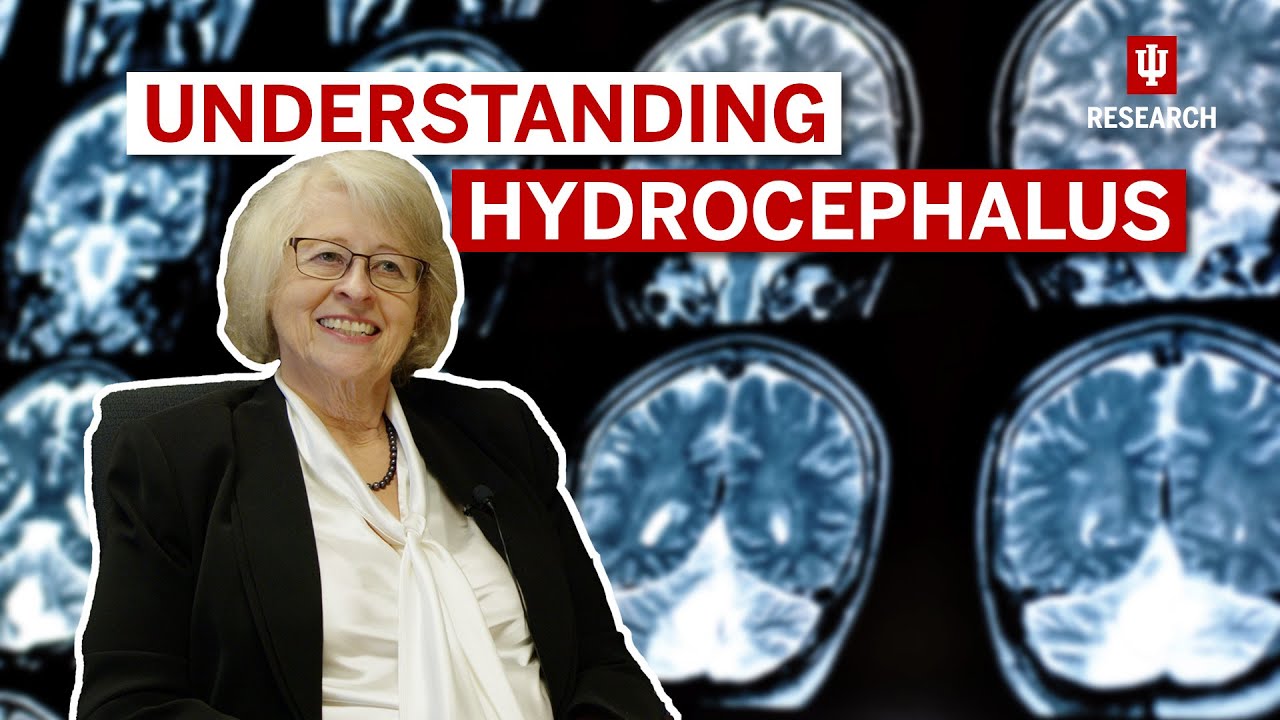 Discovering a new treatment for hydrocephalus