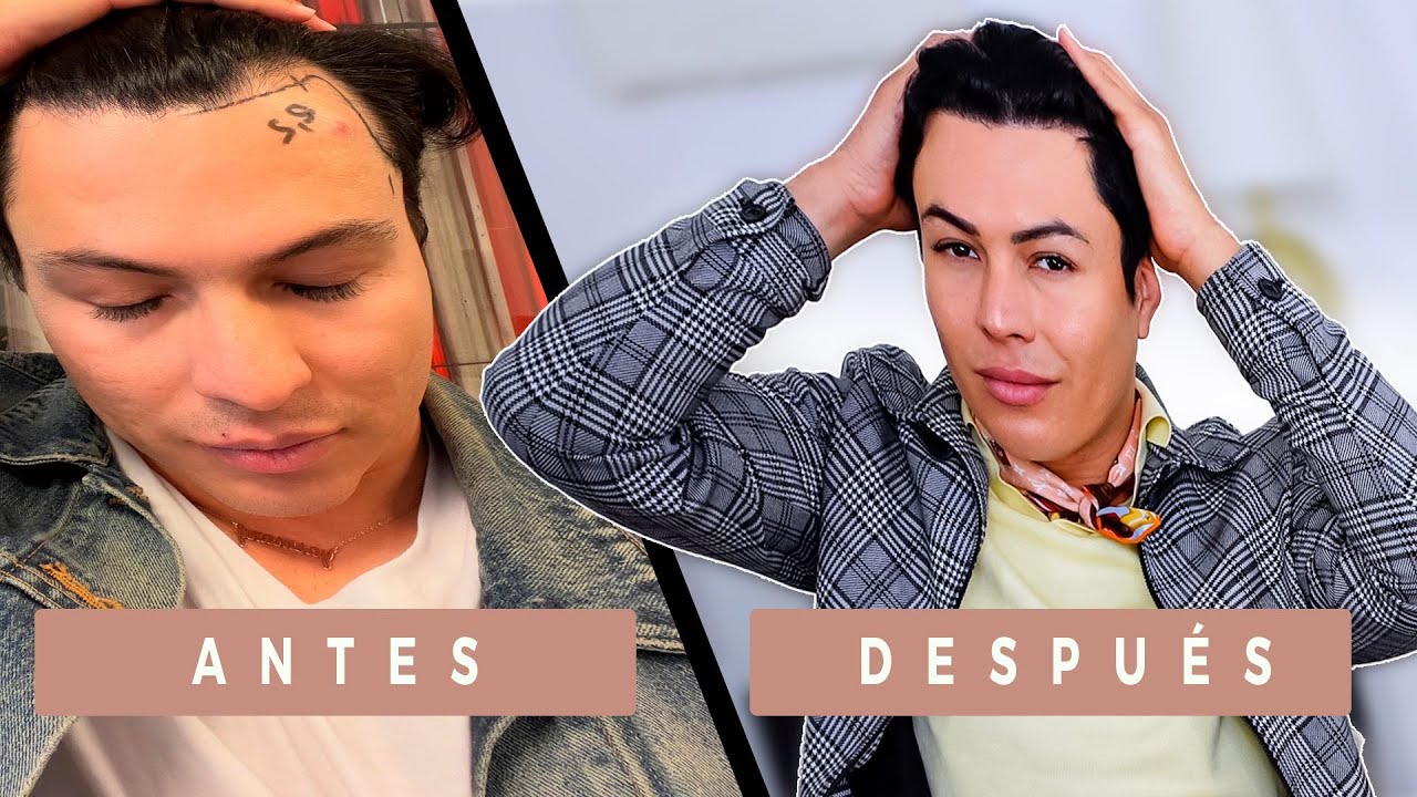 Revelando Mi Transformación: ¡Un Año Después de Mi Trasplante Capilar!