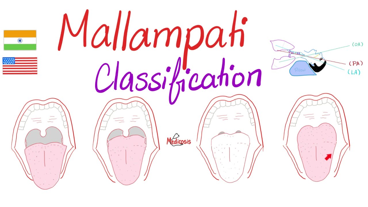 Mallampati Score (Classification) for Airway Management - Anesthesiology