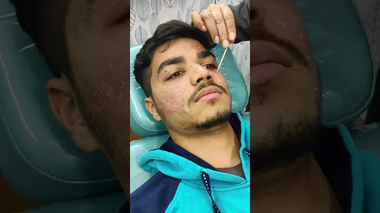 TCA CROSS for acne scars | GRACE CLINIC Dehradun | acne scar treatment, Pragyanjal step1