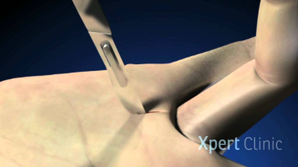 Triggerfinger operatie - Xpert Clinic