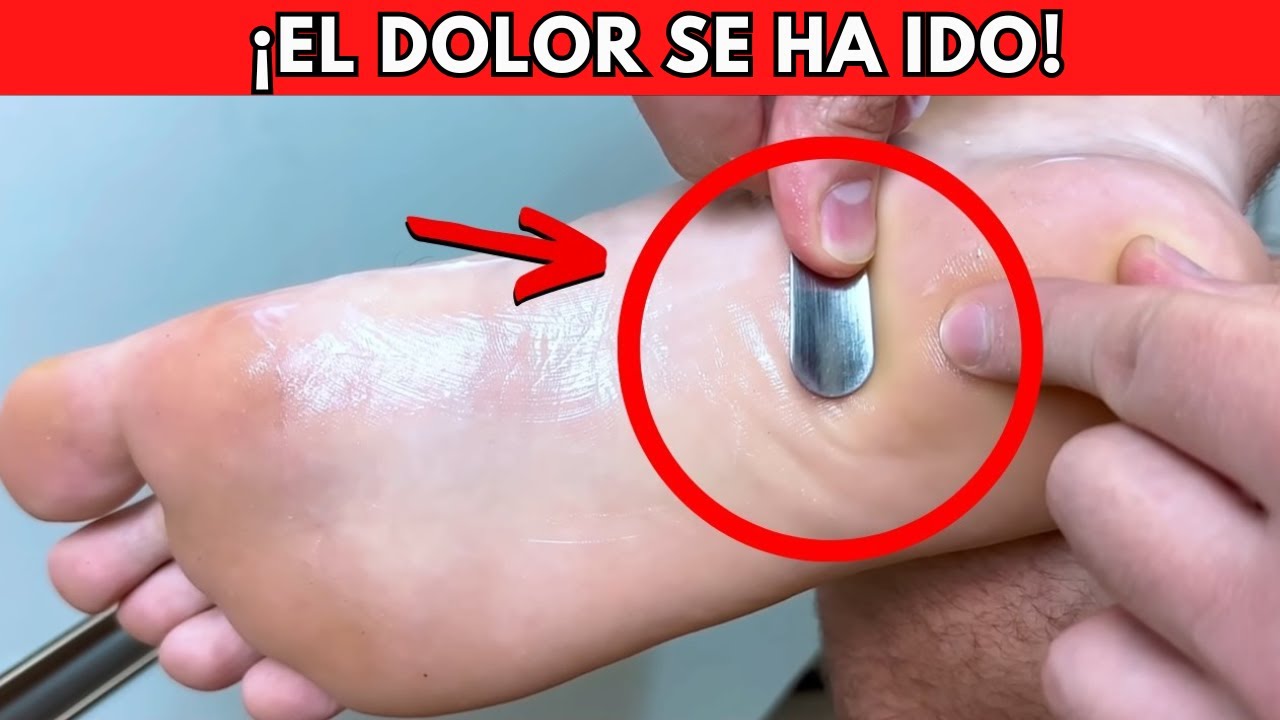 Fascitis plantar: tratamiento casero que realmente funciona