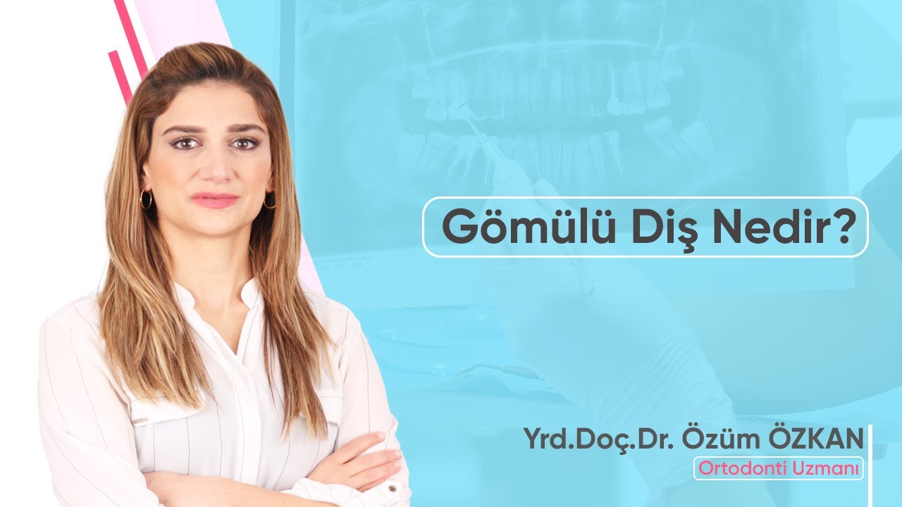 Gömülü Diş Nedir?
