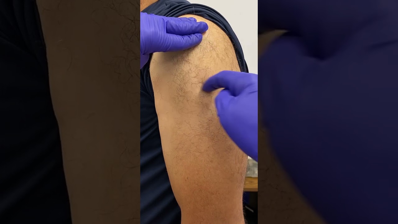 MHE Z Track Technique for IM Injections