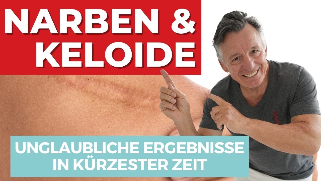 Narben & Keloide - Unglaubliche Ergebnisse in kürzester Zeit 🍀 Wir zeigen wie!