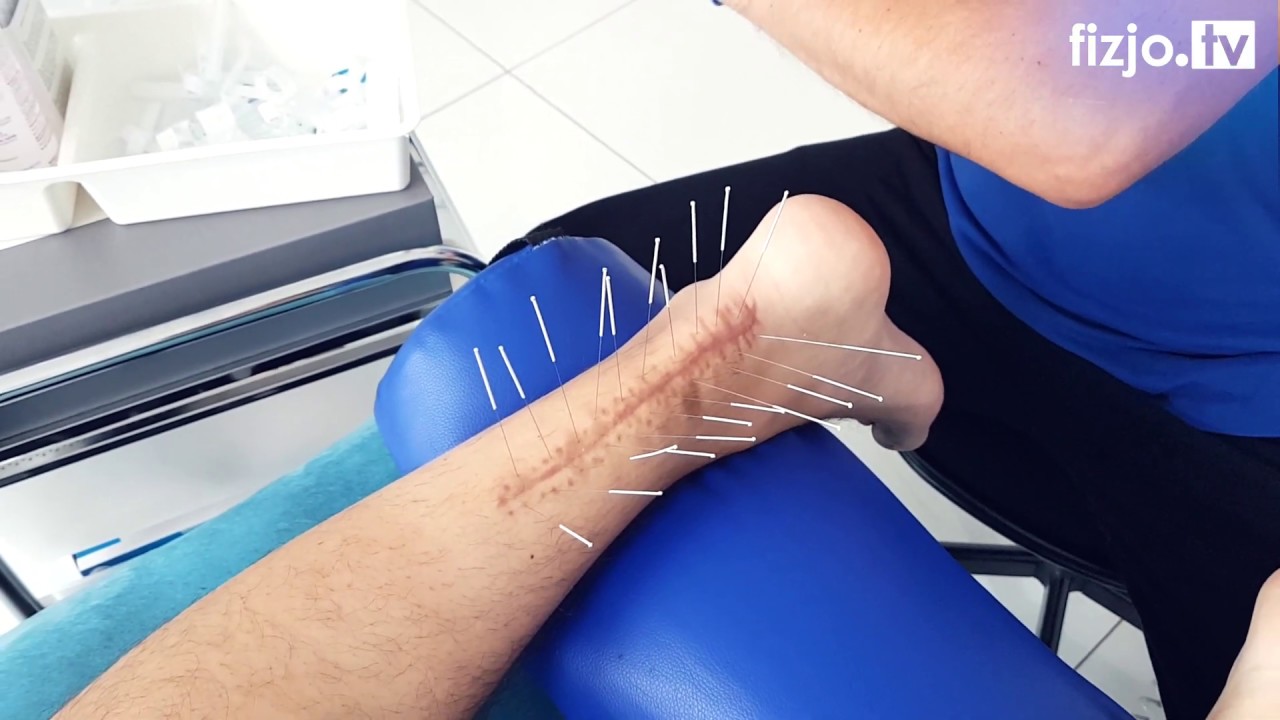 Zerwane ścięgno Achillesa - rehabilitacja